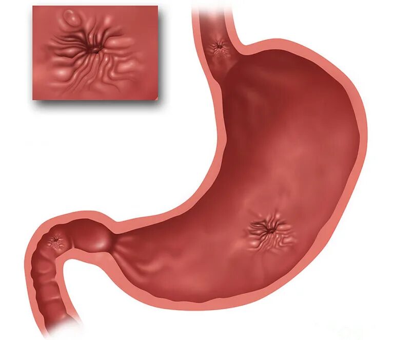 Язвенная болезнь 12 перстной кишки. Перфоративная язвенная болезнь желудка. Пилорит. Хеликобактер пилори язва желудка. Язвенная болезнь желудка и 12 перстной кишки.