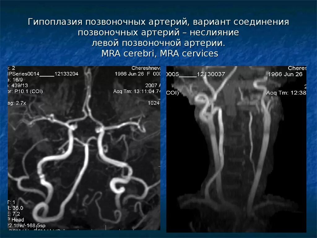 Гипоплазия правой артерии головного мозга. Гипоплазия р1 сегмента мозговой артерии. Гипоплазия v4 сегмента левой позвоночной артерии. Гипоплазия позвоночной артерии кт. Гипоплазия v4 сегмента правой позвоночной артерии.