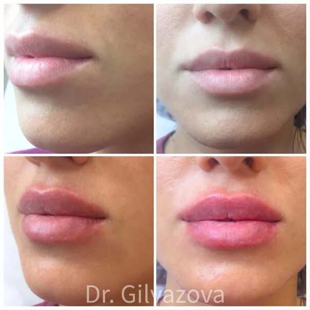 Губы после ювидерм. Juvederm Ultra smile – 0,55 мл - губы. Ювидерм 0.55. Ювидерм Смайл 0.55. Ювидерм ультра Смайл 0.55 на губы.