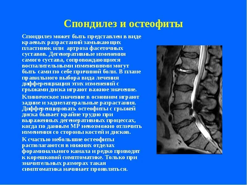 Краевые костные разрастания позвоночника. Краевые костные разрастания позвоночника