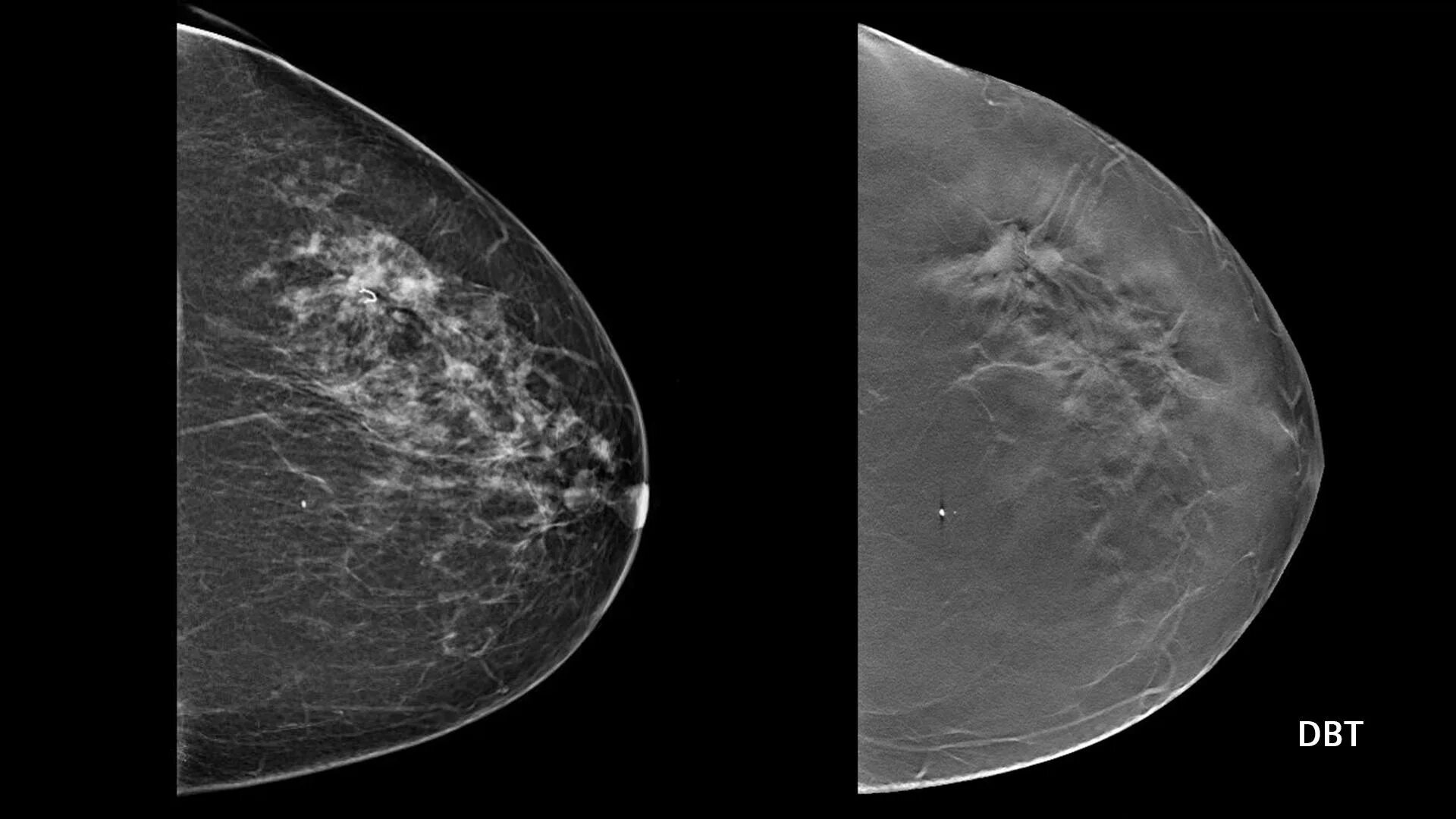 Маммография старый. Маммография здоровых молочных желез. Строение молочной железы на маммографии. Мастопатия на маммографии. Томосинтез снимок маммография.