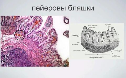 Бляшки кишечника