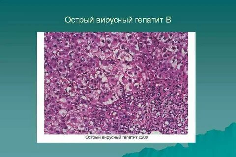 Острая токсическая дистрофия печени