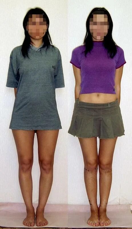 аппарат илизарова вальгусная. исправление о образных ног. аппарат илизарова исправление кривизны ног. кривые ноги у девушек. варусная деформация для кривых ног.