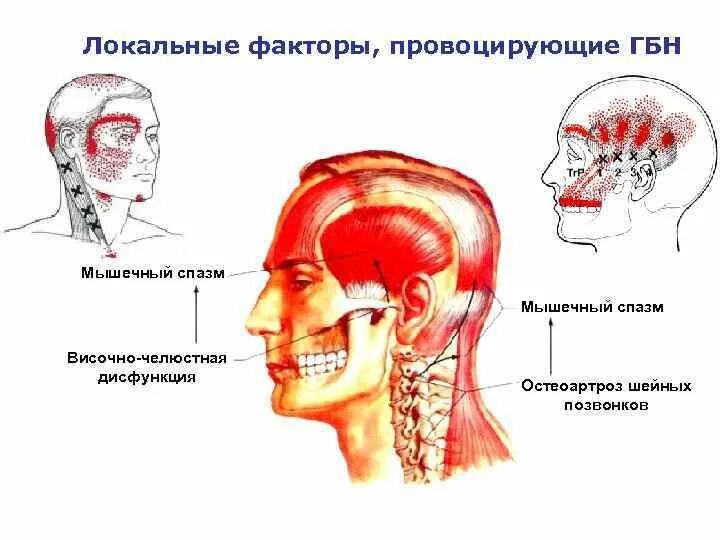 Головная боль напряжения это. Головная боль напряженного типа. Этиология головной боли. Головная боль напряжения мышцы. Головная боль напряжения локализация.