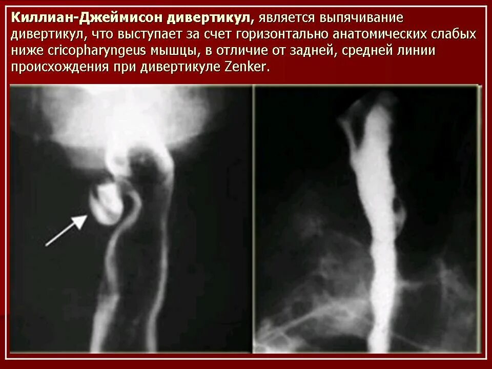 Рентгеноскопия пищевода и желудка с барием. Пищевод барретта рентген. гетеротопия желудка в пищевод. ахалазия и норма рентген.
