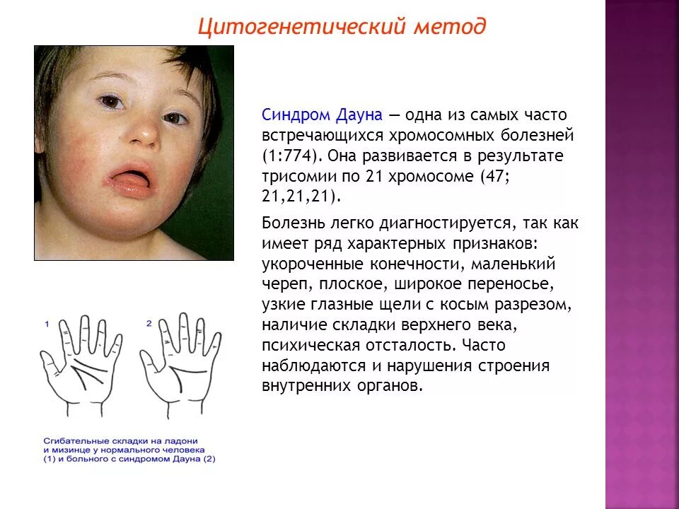 Каким методом диагностируется синдром дауна. Синдром дауна цитогенетика. методы исследования синдрома дауна.