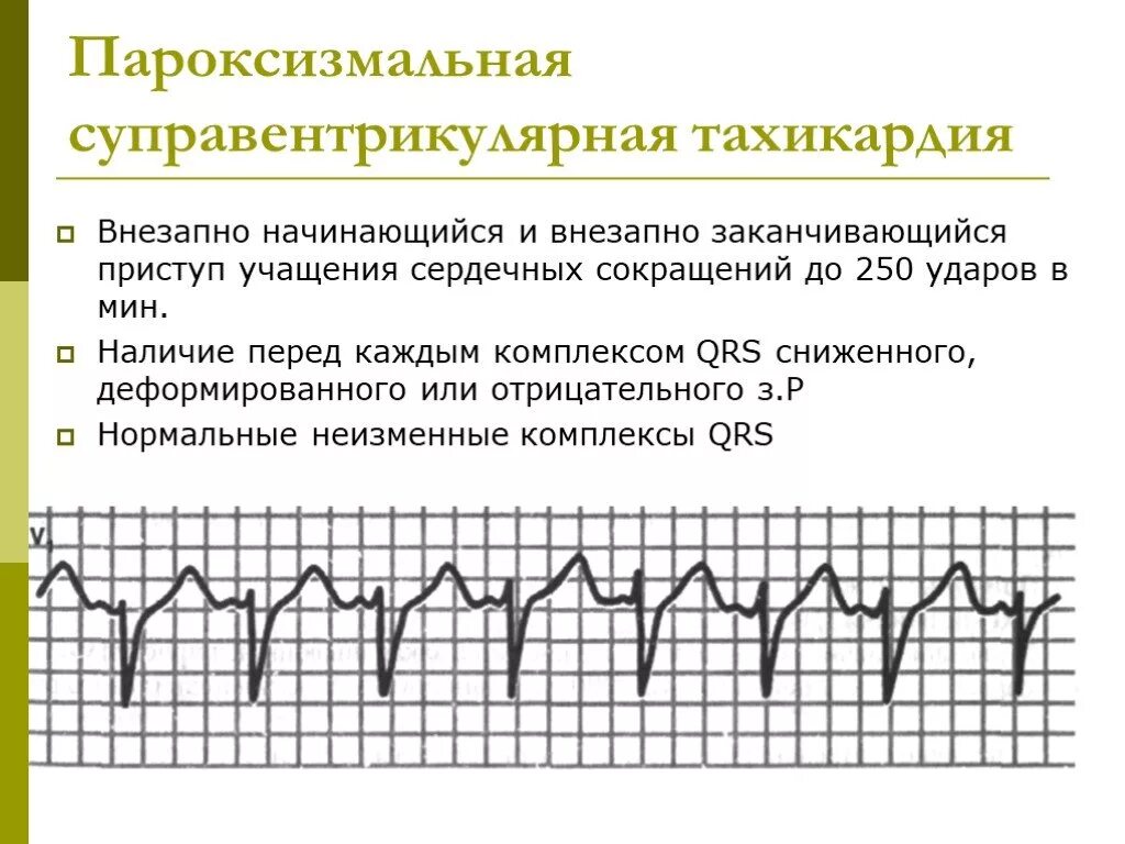 Суправентрикулярная тахикардия (свт) ЭКГ. Пароксизмальная форма субвентрикульная тахикардия ЭКГ. Суправентрикулярная пароксизмальная тахикардия на ЭКГ. Пароксизмальная наджелудочковая тахикардия ЭКГ.