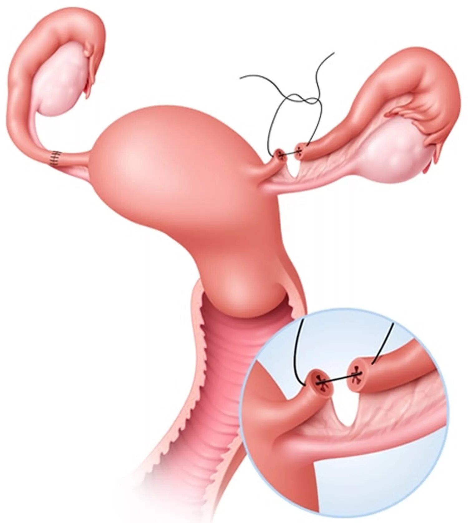Хирургическая стерилизация маточных труб. Женская стерилизация (перевязка маточных труб). Лапароскопическая перевязка маточных труб. Реанастомоз маточных труб. Удаление матки гинеколог