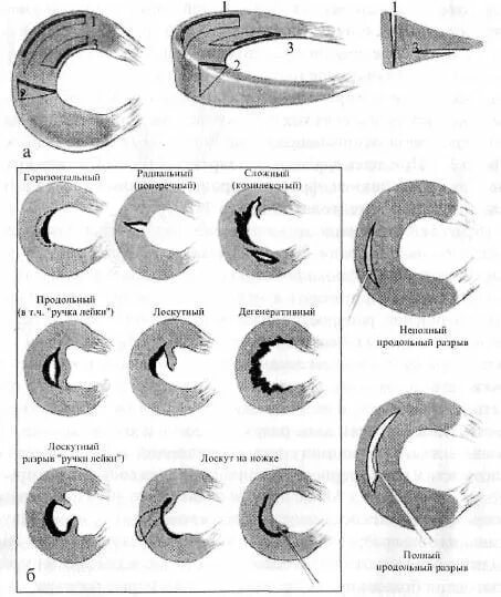Типы разрывов мениска. Классификация по Stoller повреждение мениска. Повреждение мениска 2 степени по Stoller. Классификация повреждения менисков по Stoller. Повреждение мениска 1 степени по Stoller.