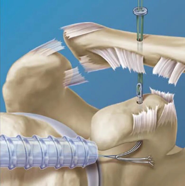 Обойтись разрыв. Артроскопическая субакромиальная декомпрессия. Пластина на акромиально-ключичное сочленение. Операция акромиально ключичного. Разрыв акромиально-ключичного сустава операция.