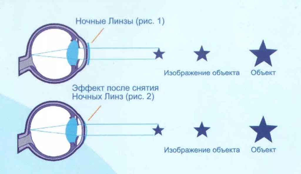 Ночные линзы для восстановления зрения. Ночные жесткие линзы для восстановления зрения. Ночные линзы для восстановления зрения принцип действия. Корректировка зрения ночными линзами. Купить ночные линзы для восстановления зрения цена