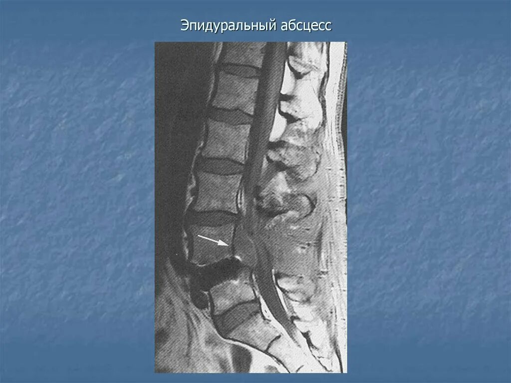 Блокада позвоночника что это такое. Эпидуральная периневральная инфильтрация. Эпидуральная плаката позвоночника. Краниальный эпидуральный абсцесс.