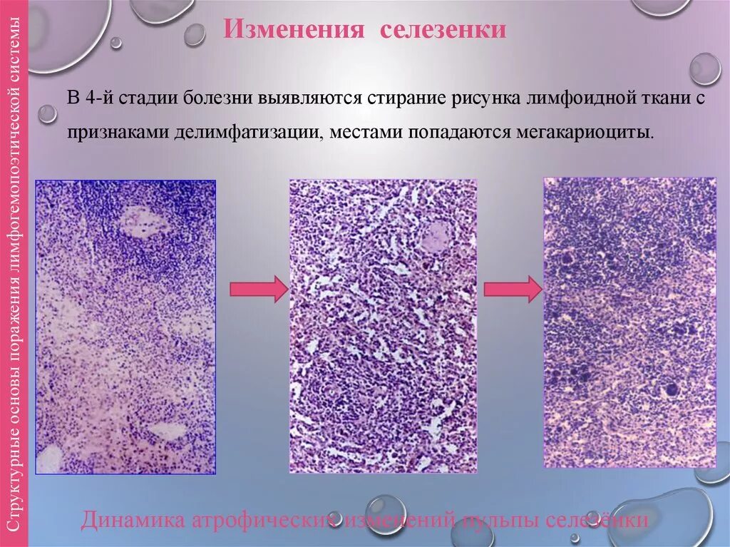 Реактивная печень у ребенка. Реактивные изменения селезенки. Делимфатизация селезенки. Изменения в селезенке гистология.