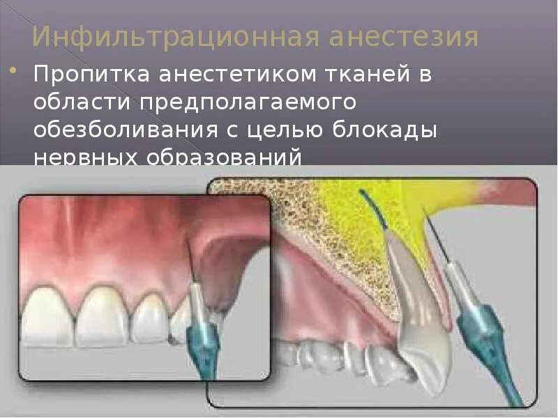 Через сколько пройдет анестезия после удаления зуба. Торусальная инфильтрационная анестезия. инфильтративная анестезия в стоматологии это. послойная инфильтрационная анестезия. инфильтрационная анестезия переходная складка.