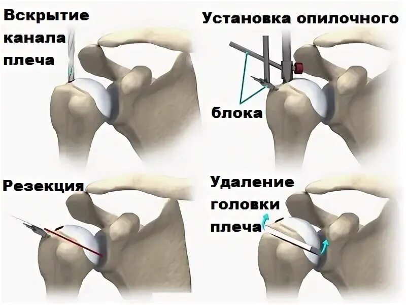Как проходит операция плечевого сустава. Подвывих протеза плечевого сустава. реверсивное эндопротезирование плечевого сустава. имплант плечевого сустава. артропластика плечевого сустава ход операции.