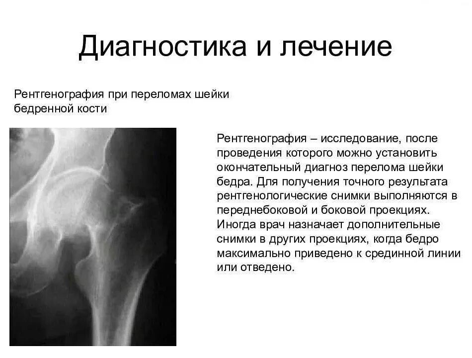 Перелом бедренной кости симптомы. Переломы шейки бедра классификация рентген. описание рентгенограммы бедренной кости. вколоченный перелом шейки бедра рентген описание. заключение рентгенограммы перелома шейки бедра.