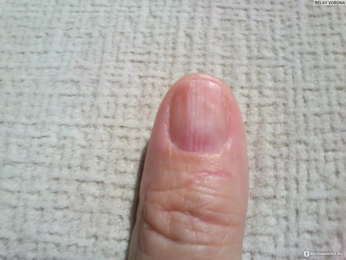 Полоски на ногтях причины вертикальные у женщин. Продольная меланонихия. Ребристые ногти на руках причины.
