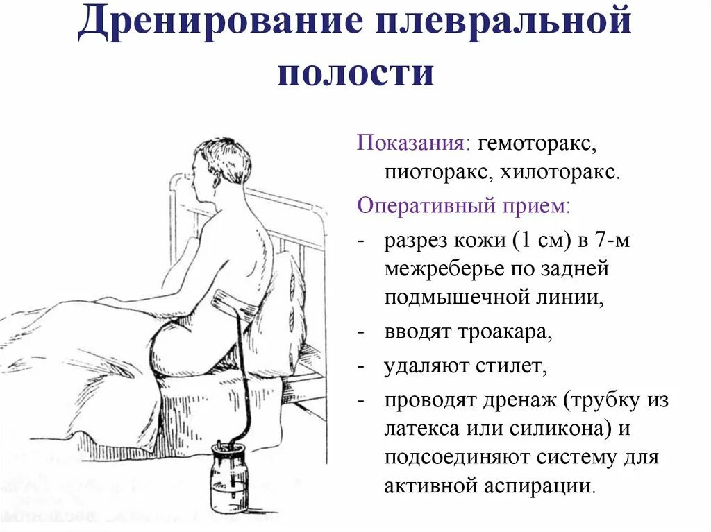 Лечение плевральной полости. Дренирование при гидротораксе техника. Дренирование плеврального выпота. Дренирование плевры при гидротораксе. Методика дренирования плевральной полости.