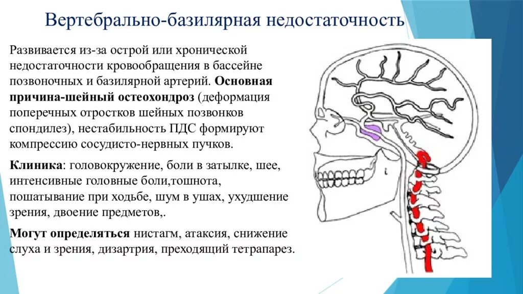 Вертебрально базилярная недостаточность. Вертебро-базилярная недостаточность. Острая вертебролизелярная недостаточность. Вертебробазиллярная нед. Синдром вертебробазилярной недостаточности.