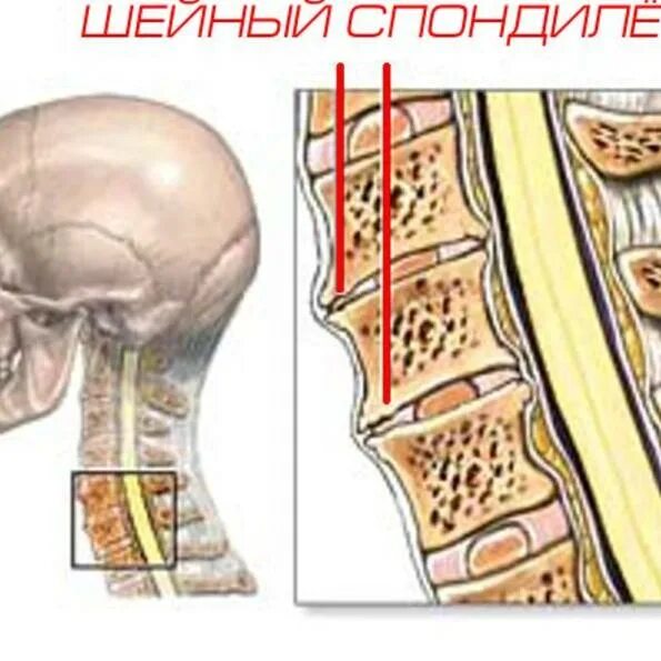 Спондилез шейного отдела. L5-s1. Деформирующий спондилез. Спондилез 3 степени поясничного отдела. Спондилёз шейного отдела позвоночника что это такое. Начальный спондилез