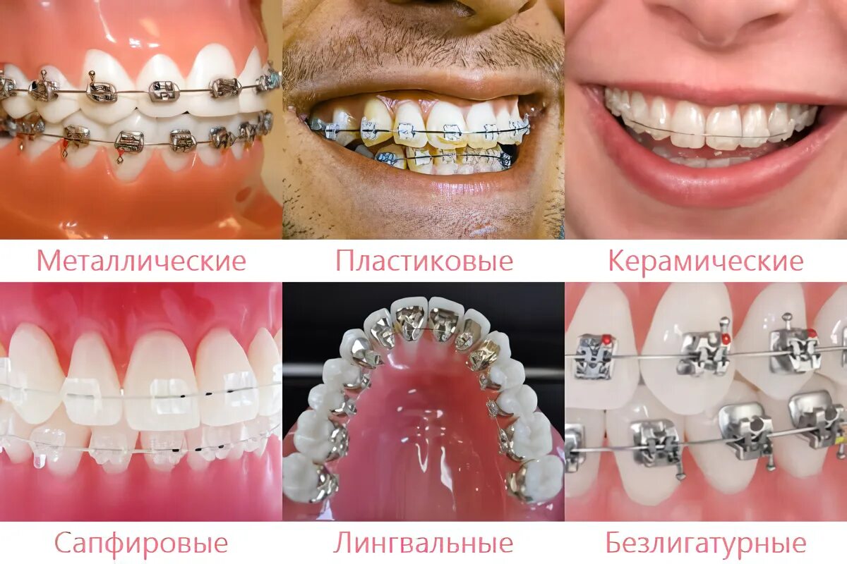 Сколько установить брекеты на зубы. Сапфировые лингвальные брекеты. керамические скобы на зубы.