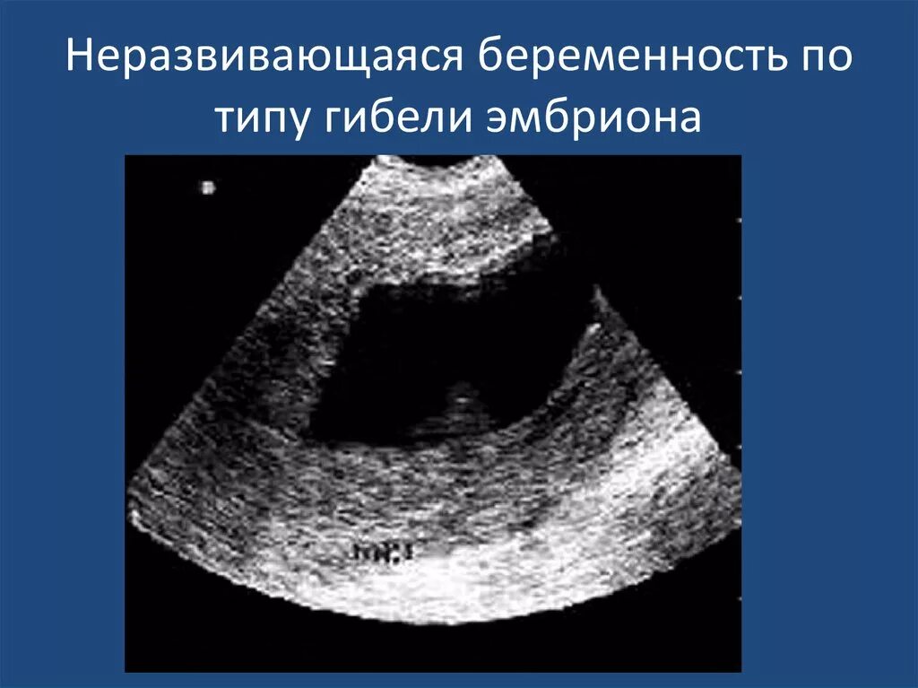 Беременность после неразвивающейся беременности