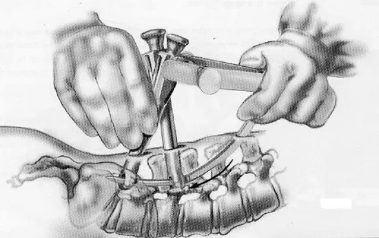 Транспедикулярная фиксация th11-l2. Операция транспедикулярная фиксация позвонков. Спондилодез поясничного отдела позвоночника. Транскутанная фиксация позвоночника. Операция на позвоночник с металлоконструкцией инвалидность