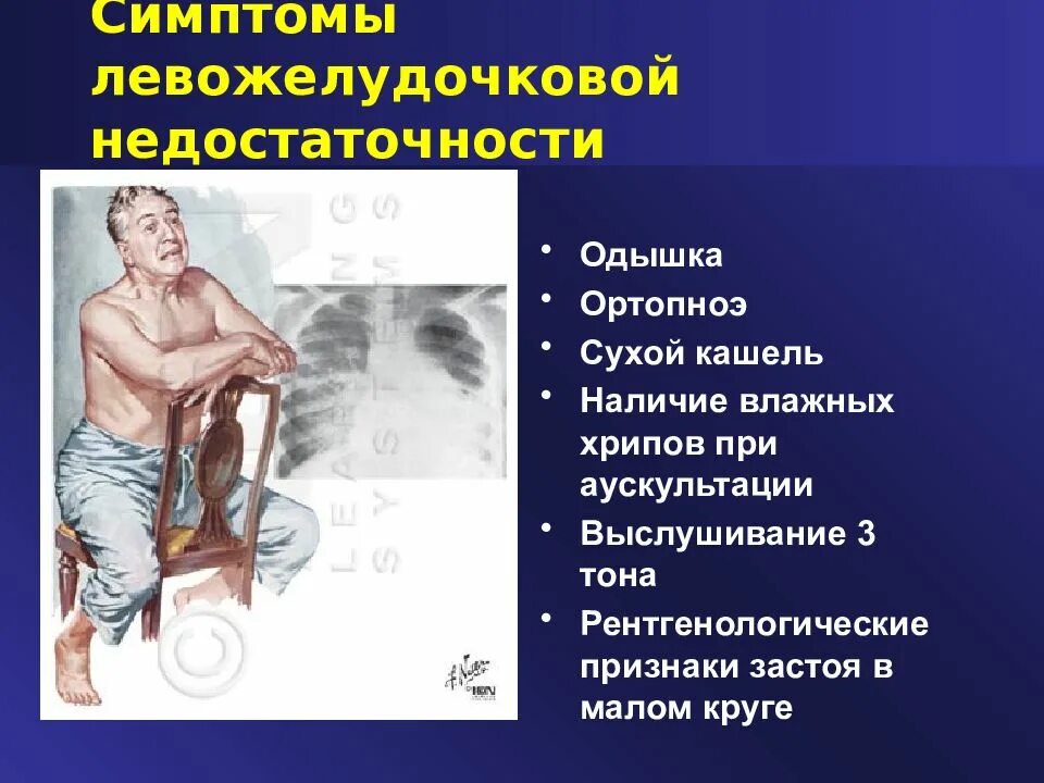 Факторы риска острой левожелудочковой недостаточности. Левожелудочковая недостаточность одышка. Хроническая левожелудочковая недостаточность причины. Причины хсн левожелудочковая недостаточность. Острая левожелудочковая недостаточность.