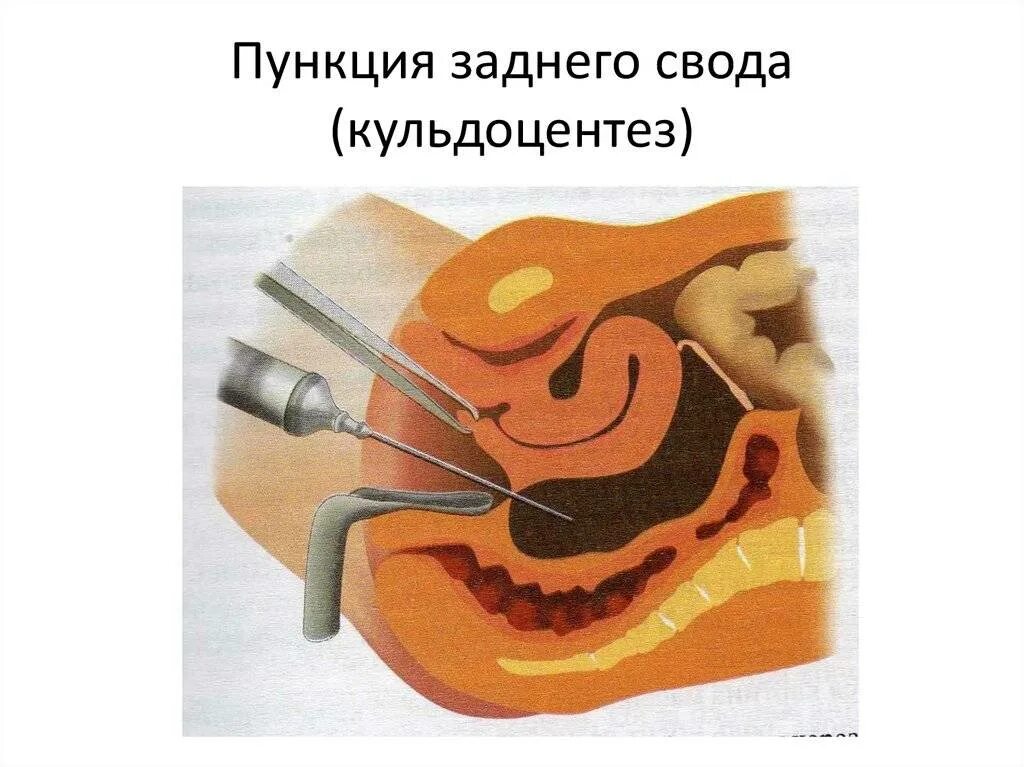 Задний свод матки. Пункция заднего свода влагалища (кульдоцентез). пункция брюшной полости в гинекологии. техника пункции заднего свода в гинекологии инструменты. показания для выполнения пункции заднего свода влагалища.