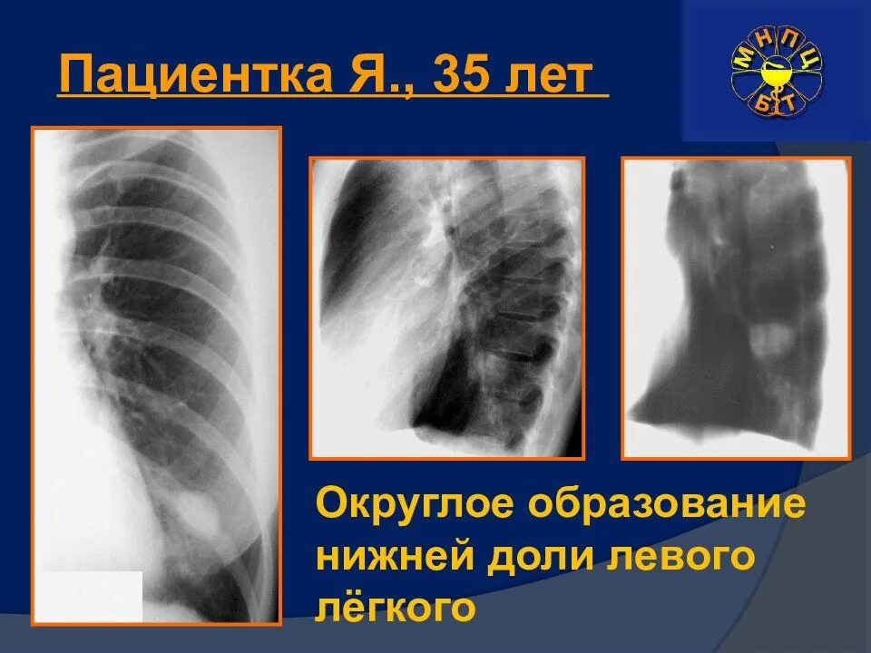 Округлое образование в легких. Округлых образования в лёгких. Образования в легких на рентгене. Образование нижней доли левого легкого. Округлое затемнение