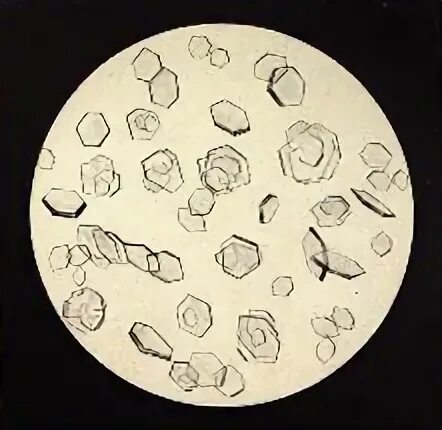 Повышен цистин в моче. Цистин в моче микроскопия. Кристаллы цистина в моче микроскопия. Кристаллы цистина микроскопия. Кристаллы цистеина в моче.