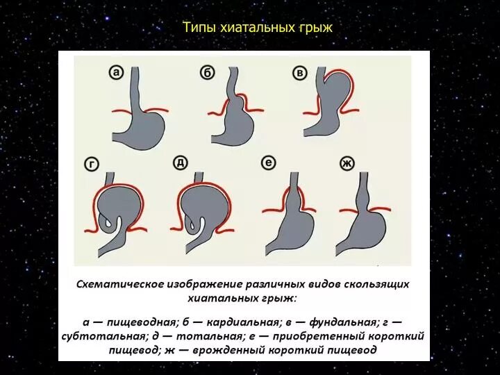 Ущемление грыжи диафрагмы. Ущемление грыжи диафрагмы