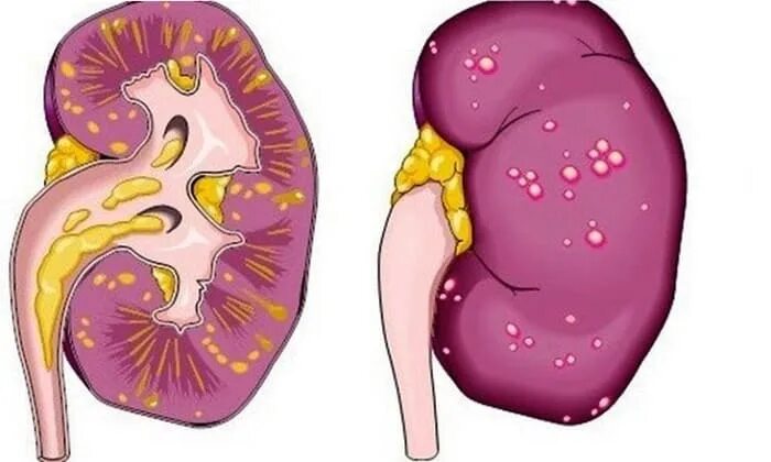 Острый апостематозный пиелонефрит. Нефрит ,пиелонефрит почек. Апостематозный нефрит. Острый пиелонефрит болезнь