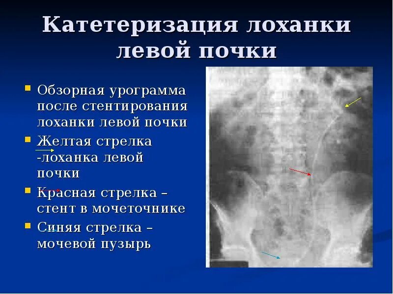 Катетеризация мочеточника, почечной лоханки. Катетеризация левой почки. Катетеризация почки показания. Стент левого мочеточника.