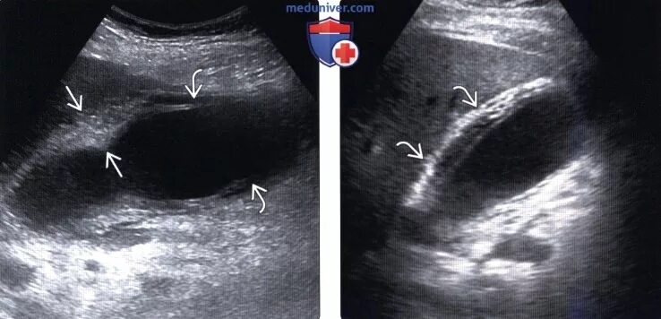 Холестероз желчного пузыря. Холестероз желчного пузыря эхограммы. Холестероз желчного пузыря по УЗИ. Холестероз стенки желчного пузыря на УЗИ.