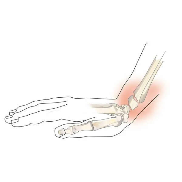 Перелом ладьевидной кости кисти левой руки. Перелом лучезапястного сустава. Штыкообразная деформация. Перелом лучевой запястной кости со смещением.