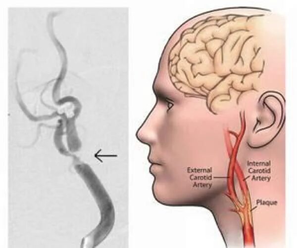 Атеросклероз сосудов брахиоцефальных артерий. Брахиоцефальные артерии, сосуды (бца). Атеросклероз сосудов бца. Сужение сонной артерии.