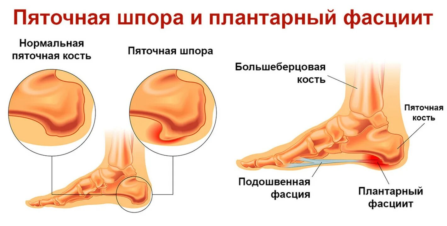 Почему появляется шпора. Подошвенная пяточная шпора. Пяточная шпора подошвенный фасцит. Подошвенный (плантарный) фасциит клиника.