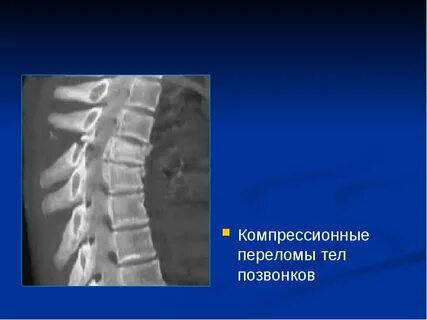 Перелом тела th11