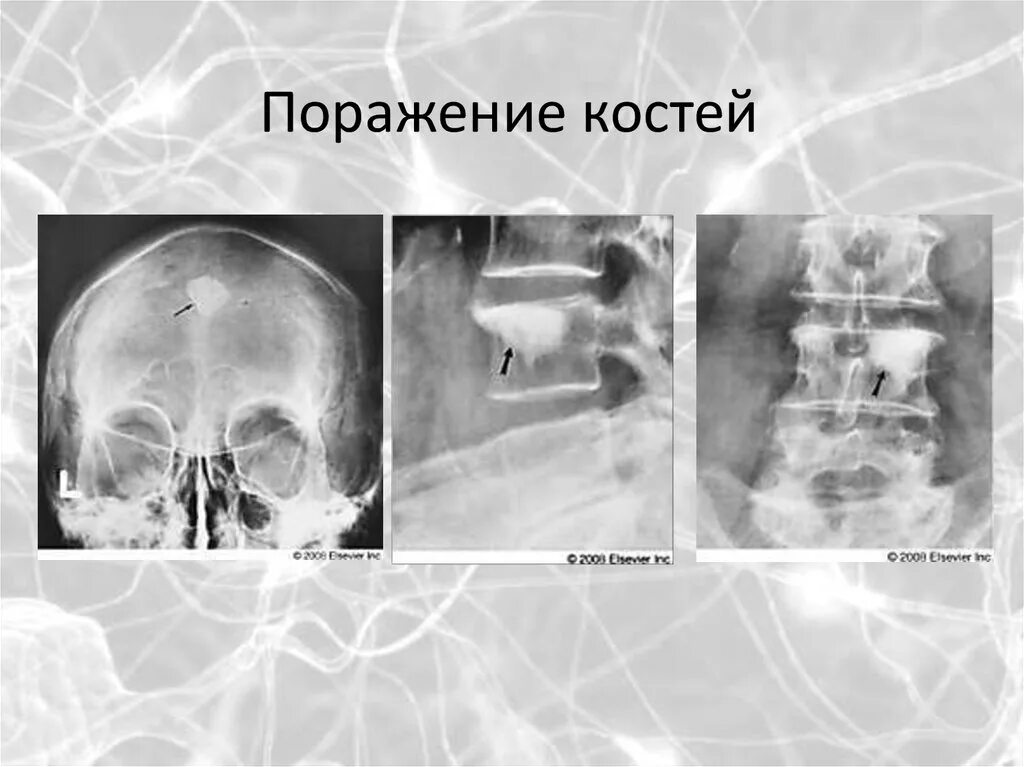 Вторичное поражение костей. Что такое вторичное поражение костей. Миеломная болезнь рентген. Кт картина миеломной болезни.