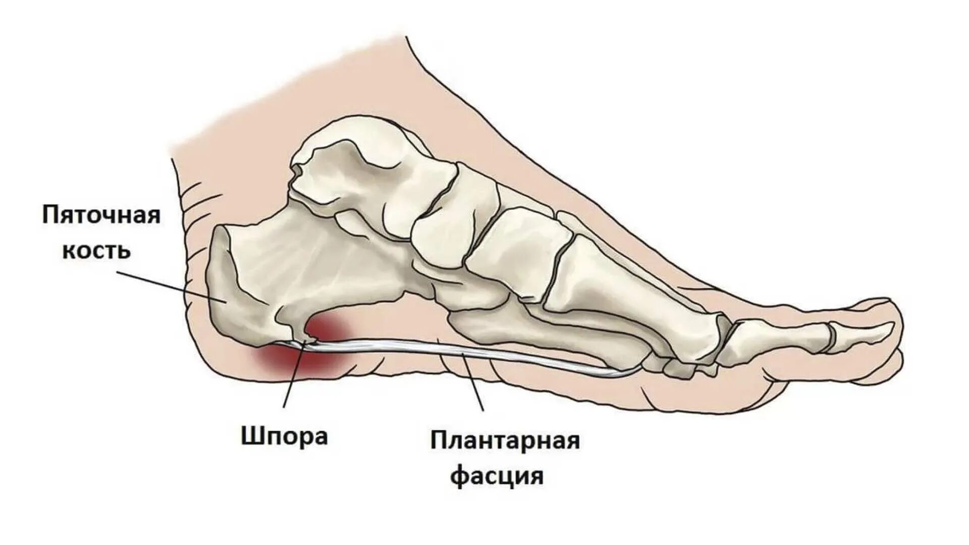 Пяточная шпора ахиллова сухожилия. Подошвенная шпора пяточной кости. Плантарный фасциит стопы.