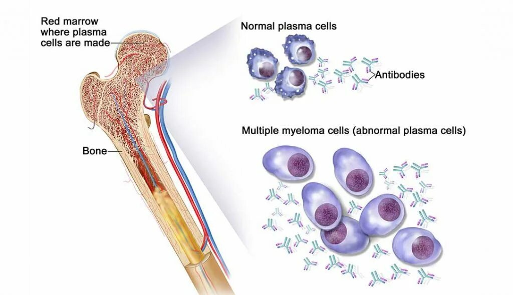 Клетки крови образующийся в костном мозге. Костный мозг при миеломной болезни. Костный мозг при множественной миеломе. Миеломная болезнь патогенез. Миеломная болезнь характеристика.