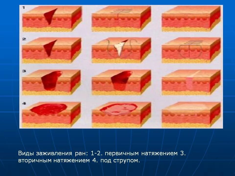 Этапы заживления ран. Заживление раны (раневой процесс). Типы заживления РАН вторичным натяжением. Типы заживления РАН под струпом. Этапы заживления резаной раны.