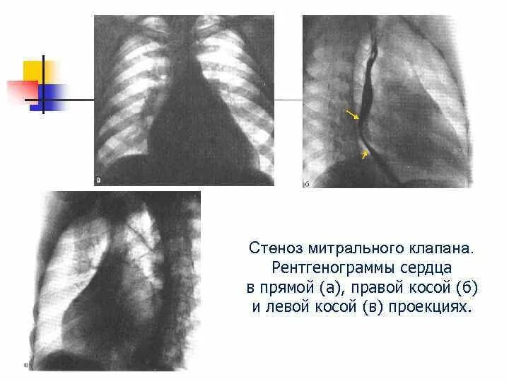 Воронкообразная грудная клетка. Стеноз грудной клетки. Митральный стеноз рентгенография. Митральная недостаточность рентген. Недостаточность митрального клапана рентгенограмма.
