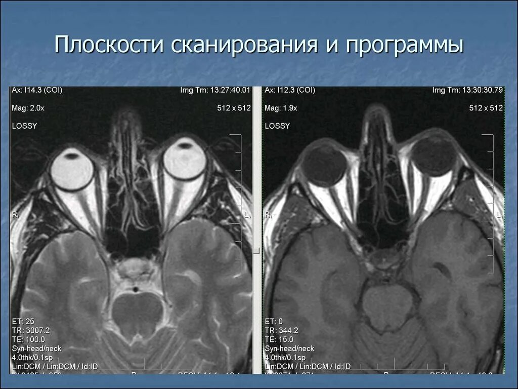 Мрт глазного нерва. Мрт глазных орбит. Мрт плоскости сканирования. Мрт глазных орбит и зрительных нервов. Мрт зрительных нервов патологии.