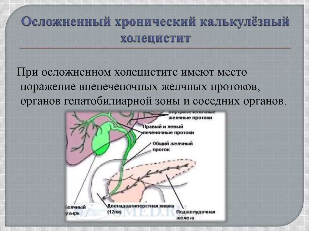 Хронический холецистит что это такое простыми словами. Хронич калькулезный холецистит. Подострый калькулезный холецистит. Хронический калькулезный холецистит симптомы. Калькулёзный холецистит симптомы.