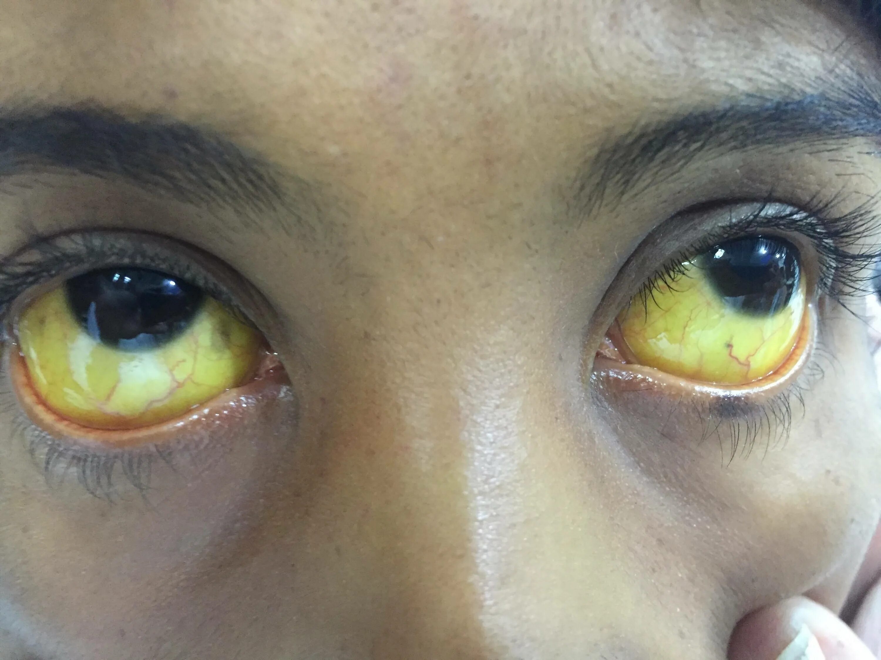Почему глаза желтоватого. Иктеричность кожных склер. Желтушность кожи и склер.