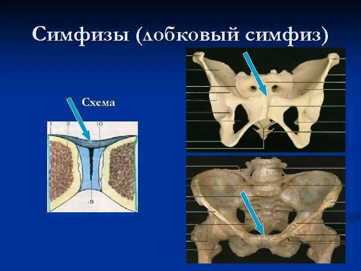 Лобковые кости соединение. Лобковый симфиз анатомия человека. Лобковый симфиз и лонное сочленение. Симфиз лобковой кости разрыв. Лобковая кость симфиз.