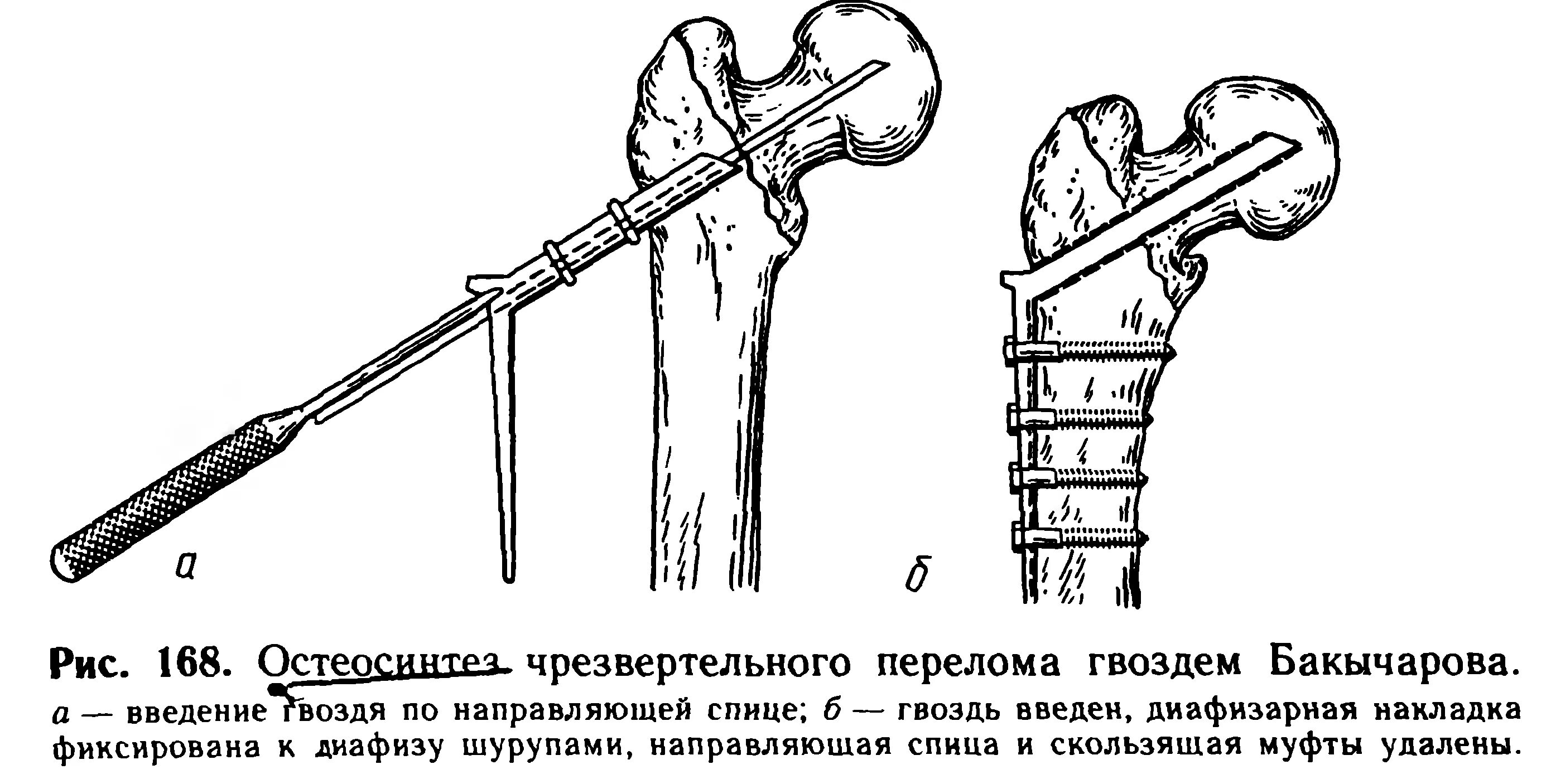 Операция остеосинтез шейки бедра. Интрамедуллярный остеосинтез шейки бедра гамма. Шейка бедра перелом остеосинтез. Остеосинтез вертельного перелома. Остеосинтез шейки бедра трехлопастным гвоздем.